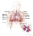 asthma nasal allergy rhinitis
